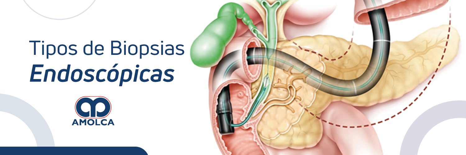Tipos de Biopsias Endoscópicas Tipos de Biopsias Endoscópicas