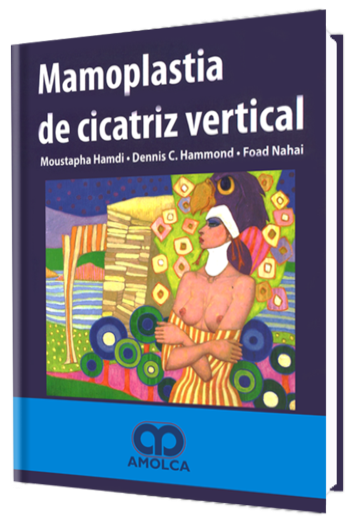 Mamoplastia de Cicatriz Vertical