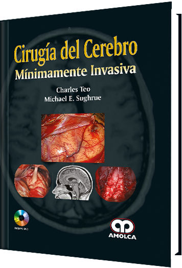 Cirugía del Cerebro Mínimamente Invasiva