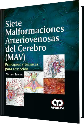 Siete Malformaciones Arteriovenosas del Cerebro (MAV)