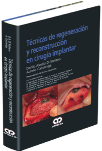 Técnicas de Regeneración y Reconstrucción en Cirugía Implantar