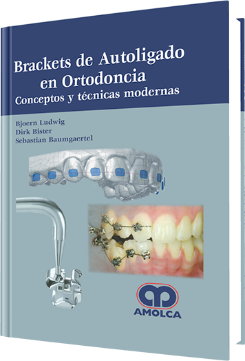 Brackets de Autoligado en Ortodoncia