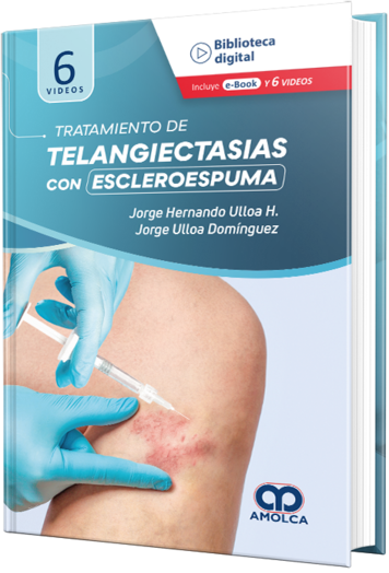 Tratamiento de Telangiectasias con Escleroespuma